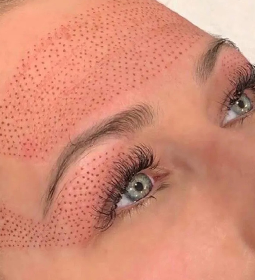 Plasma Fibroblast Facelift